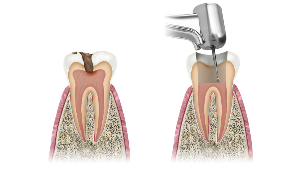 1. tooth with advAnced decay       2. removal of affected pulp from chamber