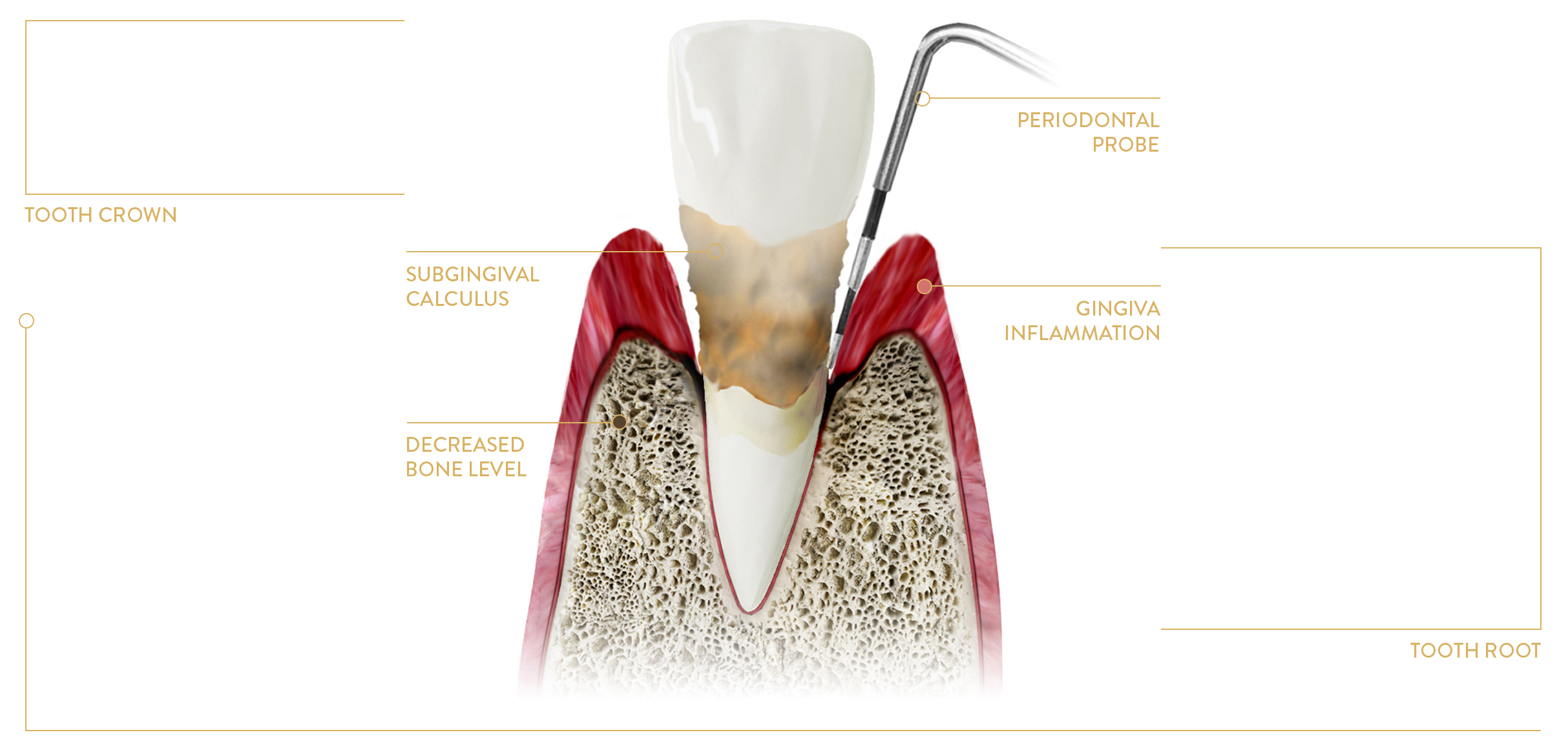 ADVANCED INFLAMMATION OF the PARODONTIUM (FORmerly known as “PERIODONTOSIS”)