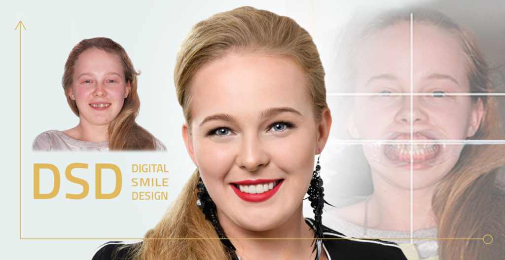 DSD - Digital Smile design