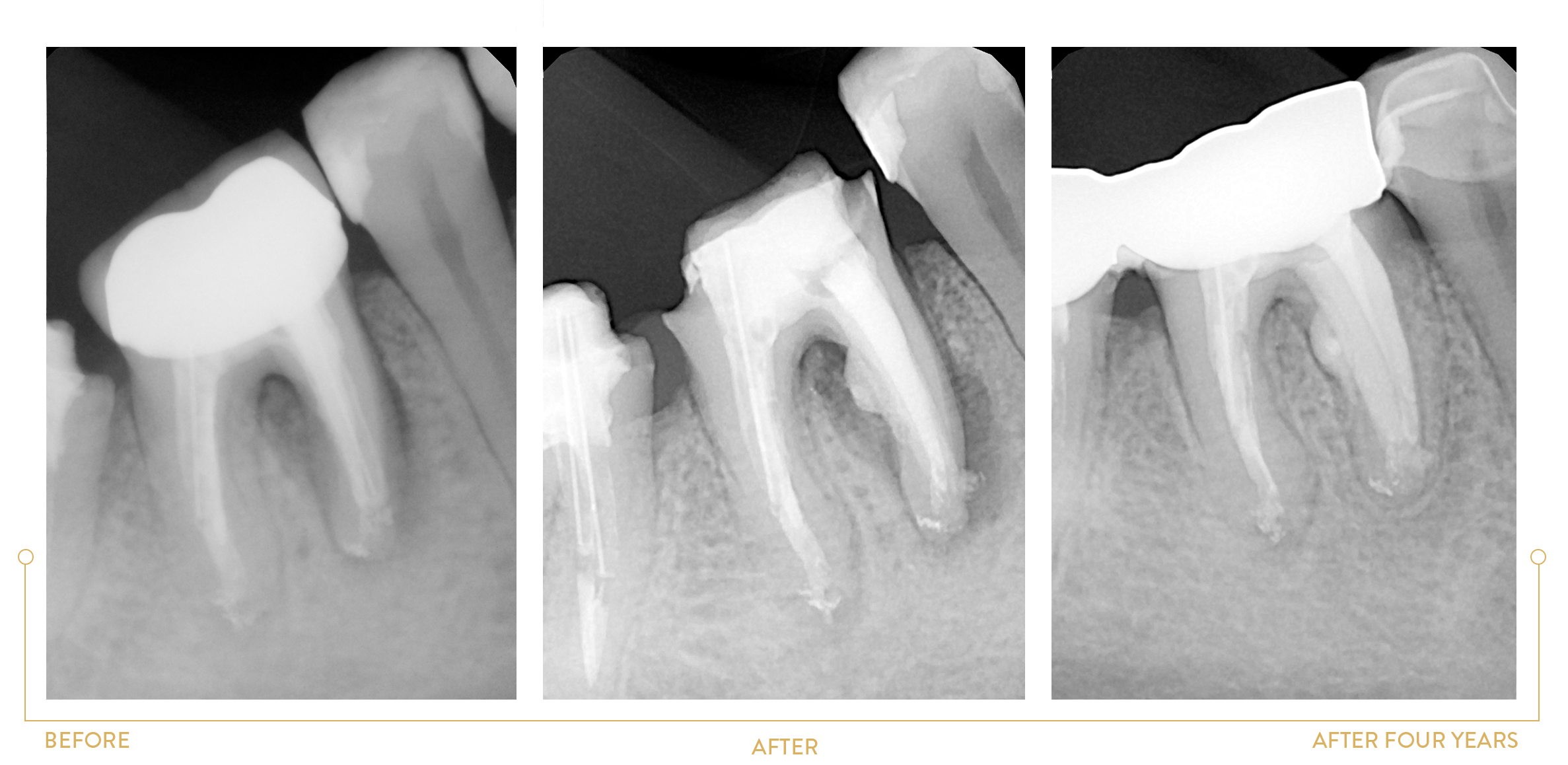 DIFFICULT PERFORATION TREATMENT