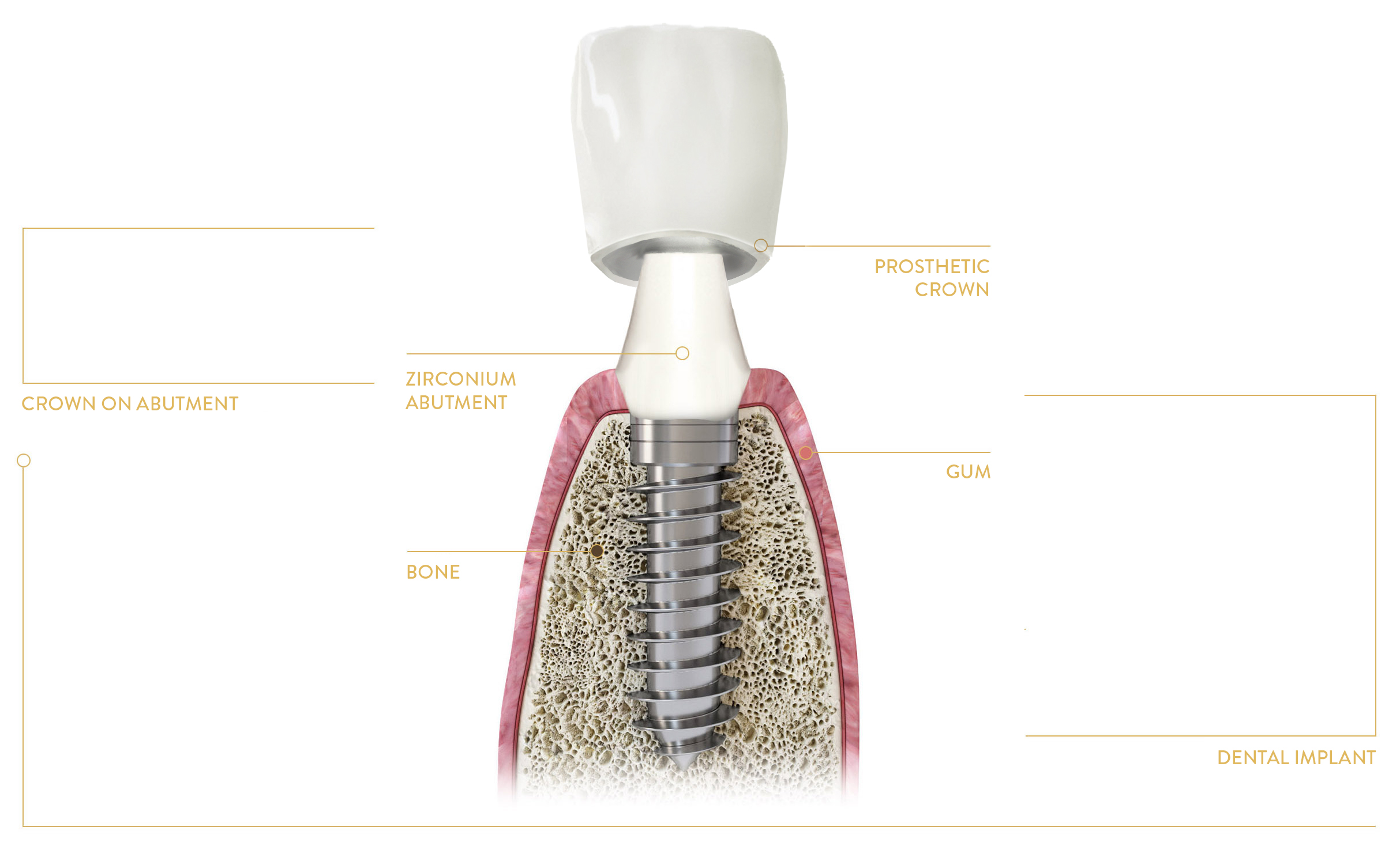 IMPLANT-SUPPORTED Crown