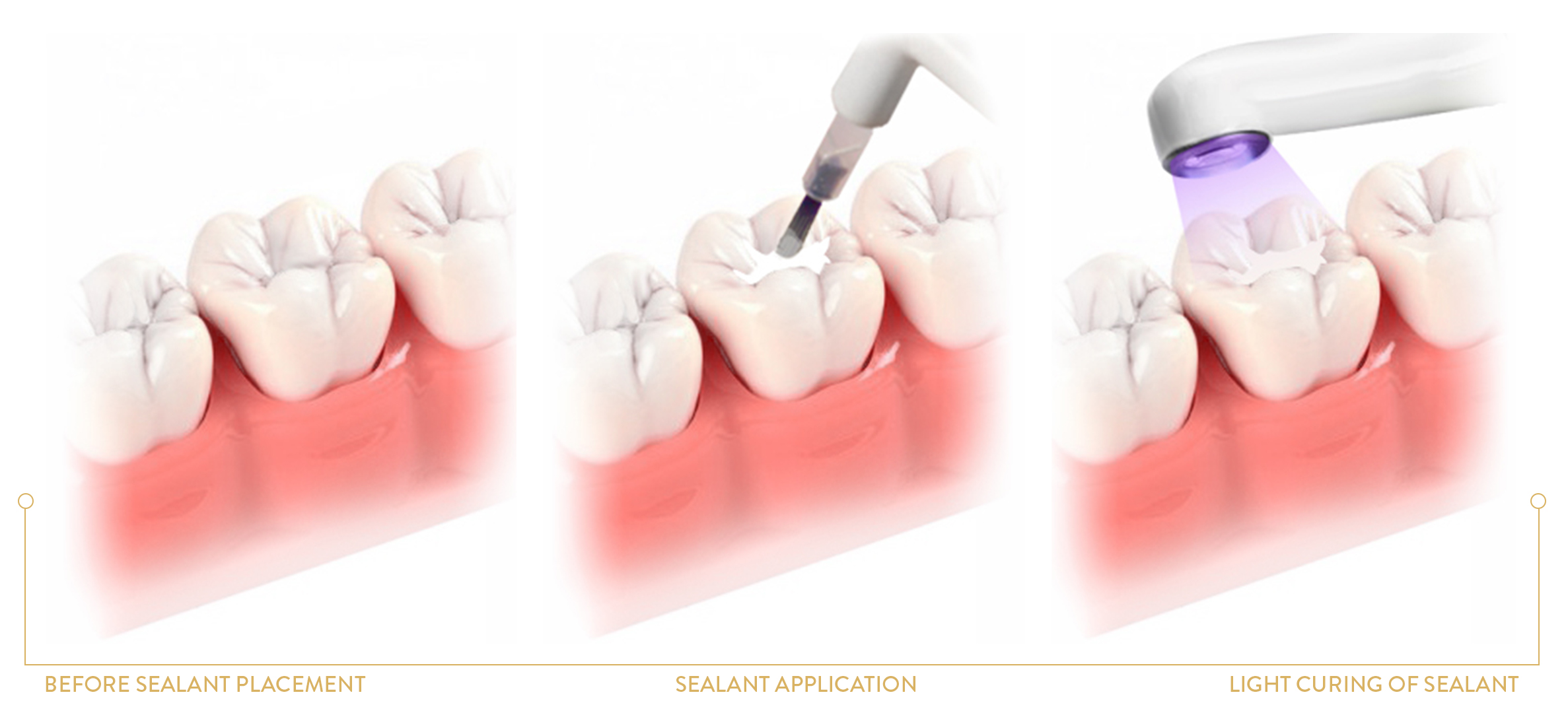 dental sealant placement