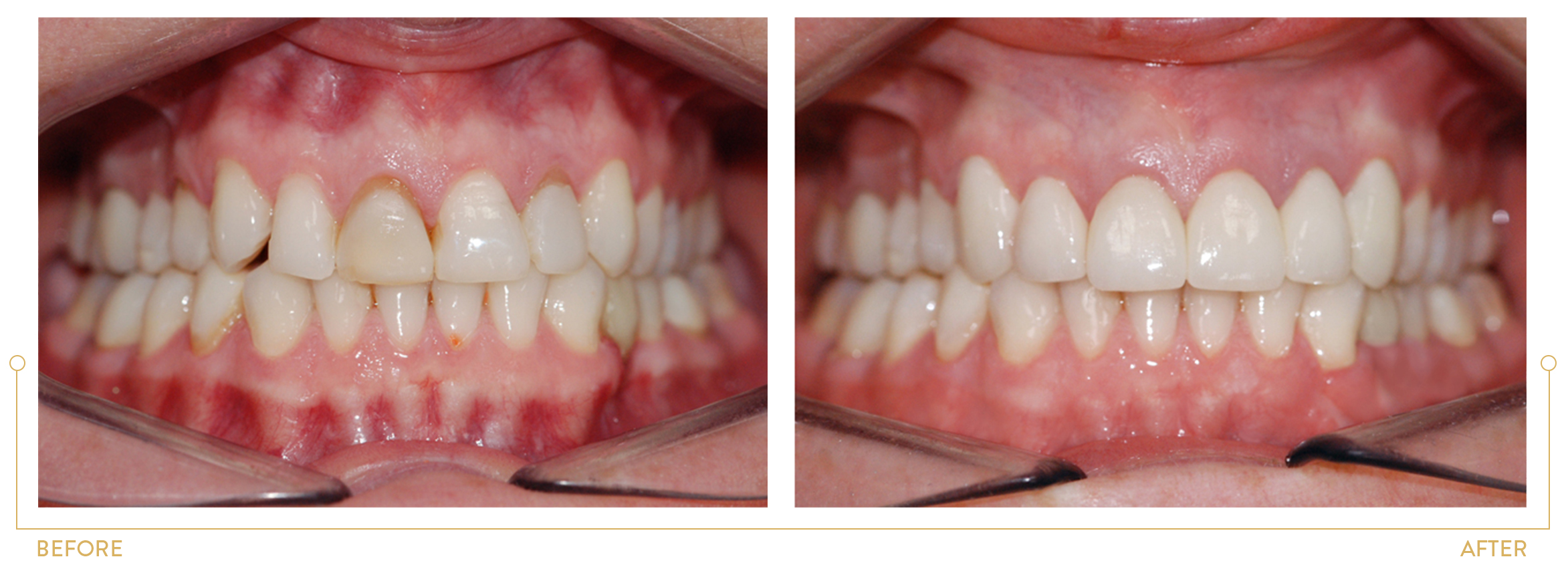 LEVELLING OF GINGIVAL LINE