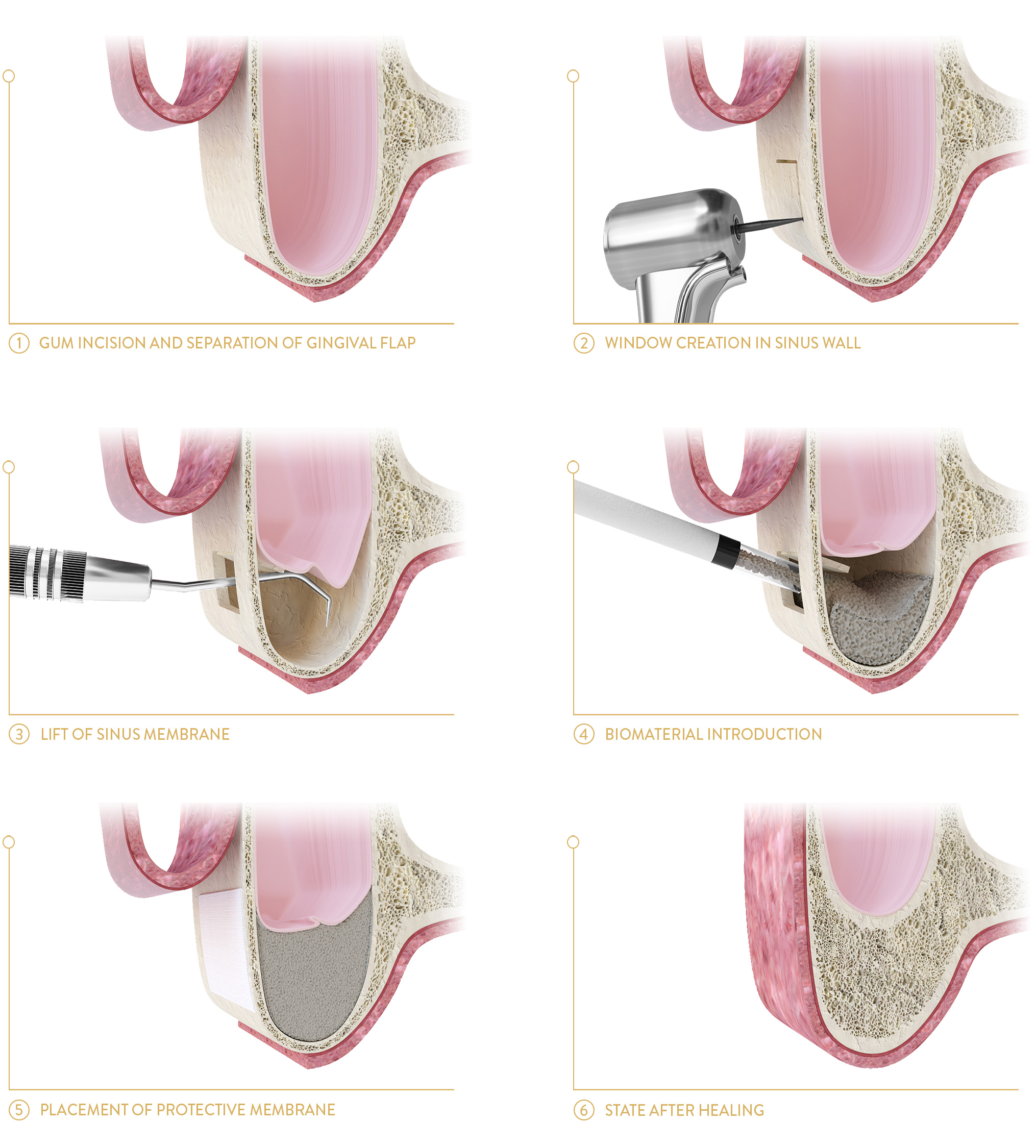 dental implant poland prices, sinus lift