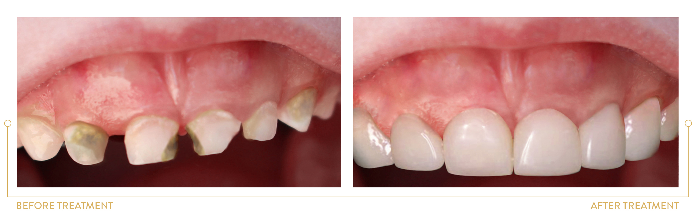 reconstruction of damaged  milk teeth using celluloid crowns
