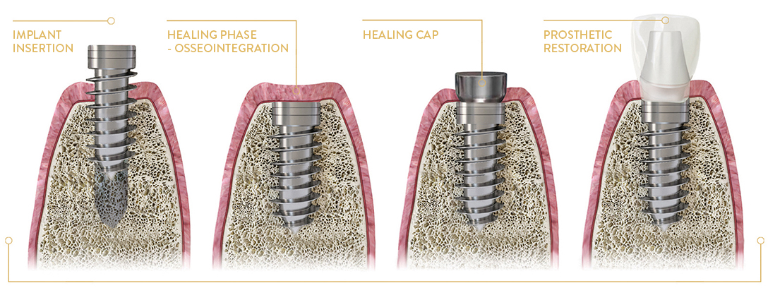poland dental implants cost, STANDARD PROCESS OF IMPLANT TREATMENT