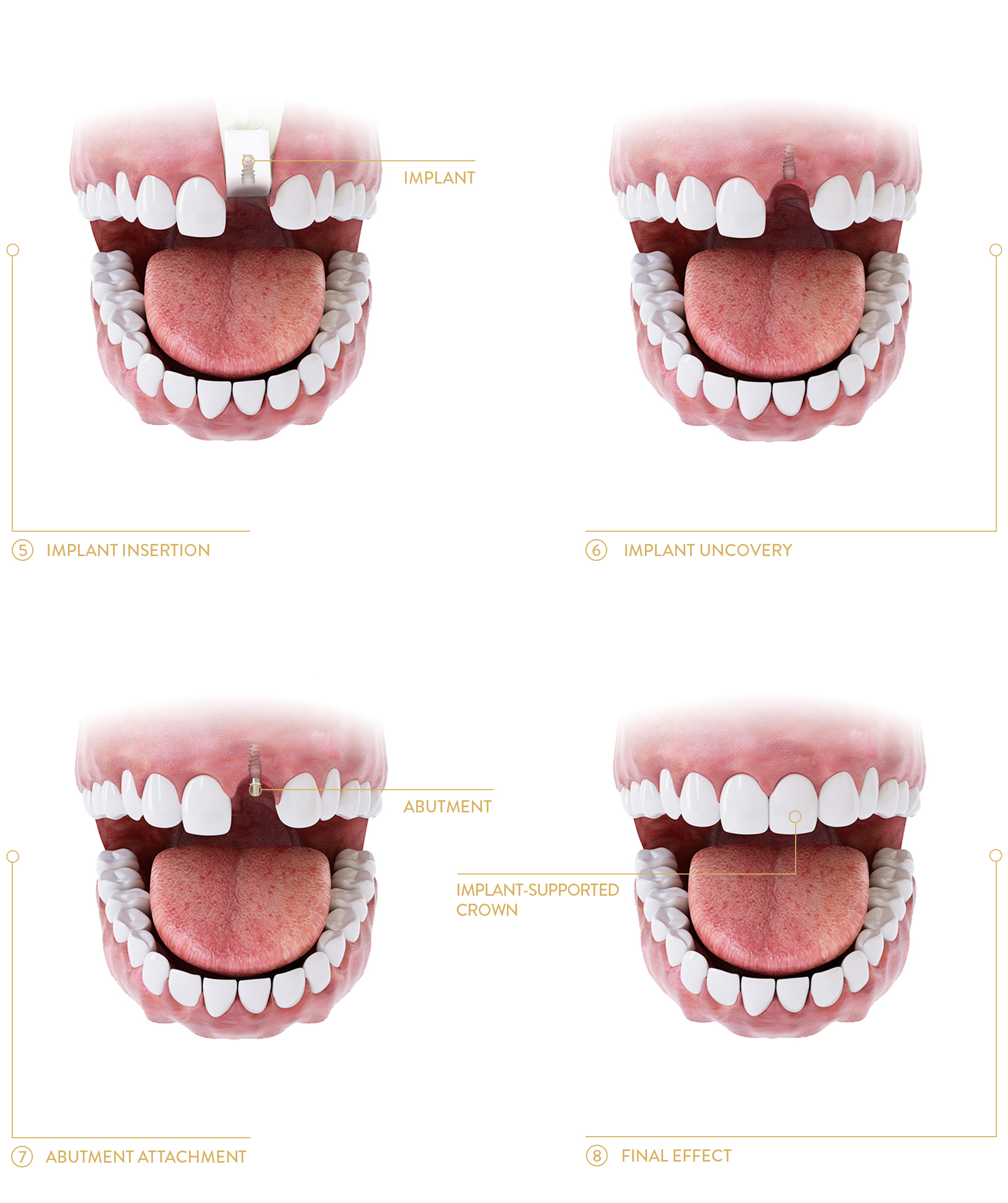 teeth implants poland, THE PROCESS OF IMPLANT-SUPPORTED PROSTHETIC TREATMENT WITH BONE reCONSTRUCTION