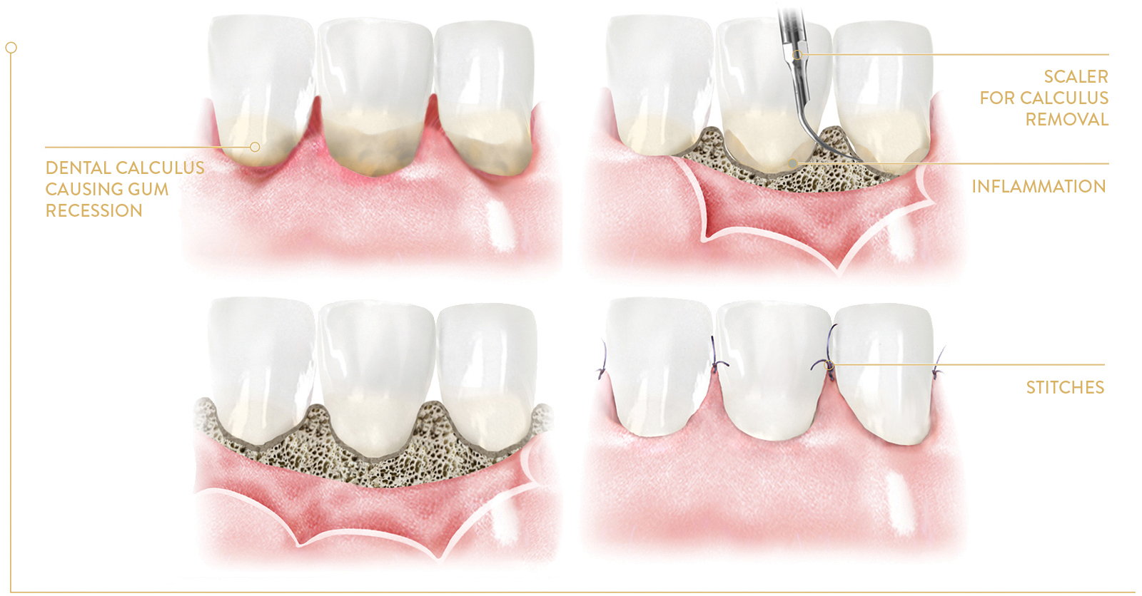 Gingival flap surgery