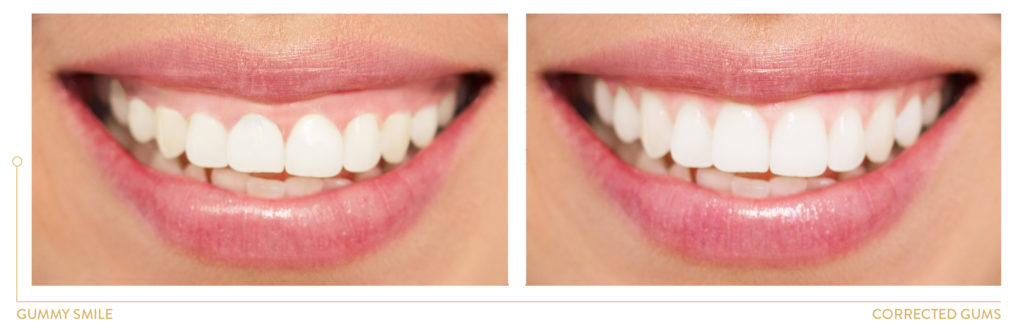 GUMMY SMILE BEFORE AND AFTER TREATMENT