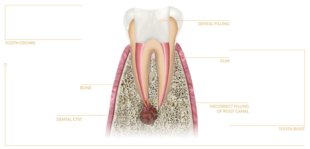 tooth intended to root apex resection procedure