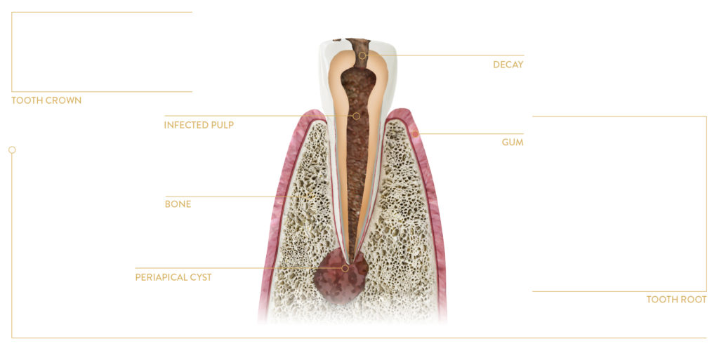 periapical cyst caused pulp infection