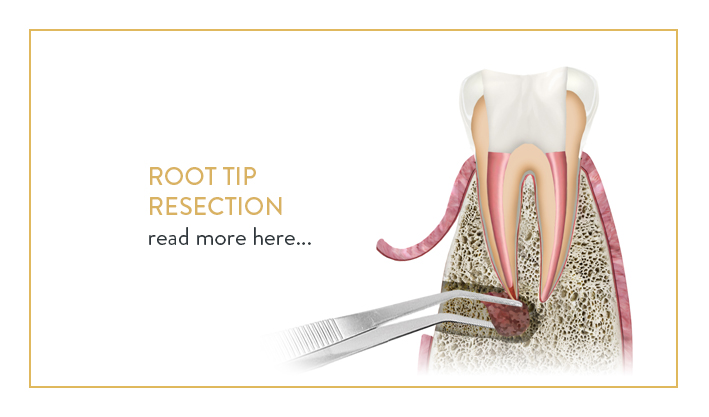root tip resection