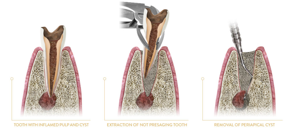 TOOTH EXTRACTION AND enucleation of PERIAPICAL cyst