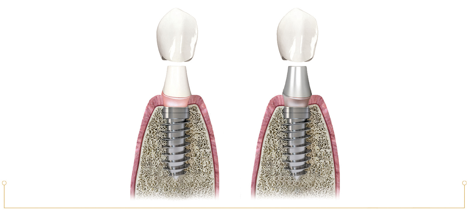 Зубы импланты поэтапно. Двухэтапная методика имплантации зубов. Двухэтапная имплантация зубов этапы. Этапы двухэтапной имплантации. Этапы имплантации зубов абатмент.